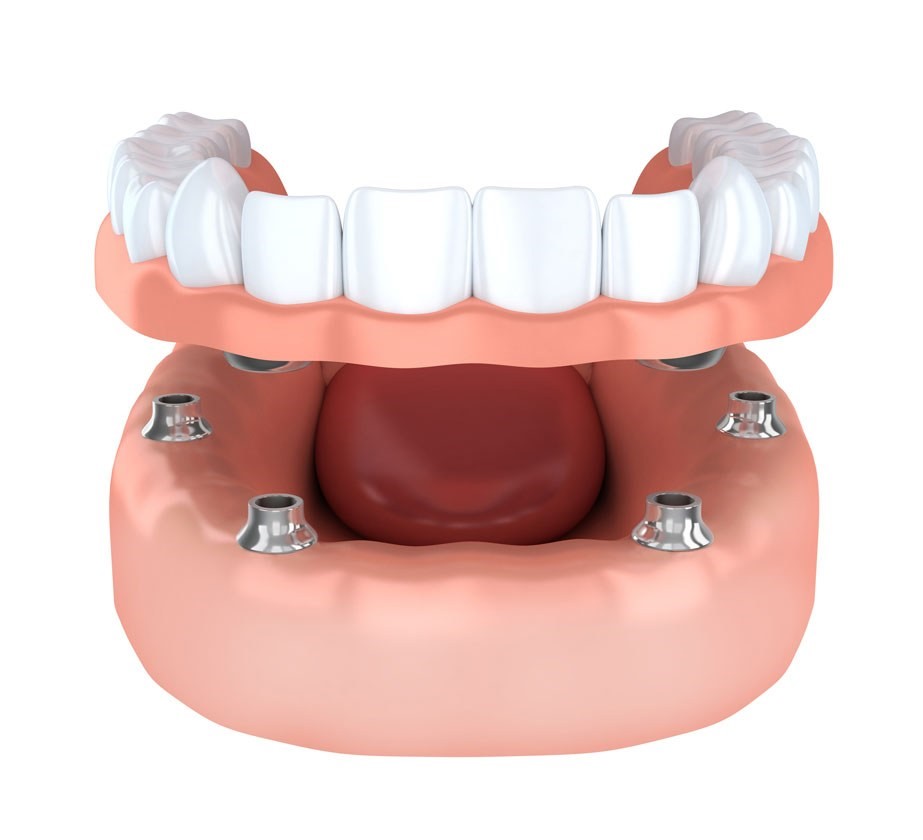 Putting In Dentures Palm Harbor FL 34684